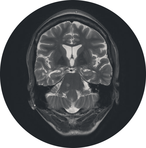 Coronal brain MRI scan used in CNS clinical trial imaging