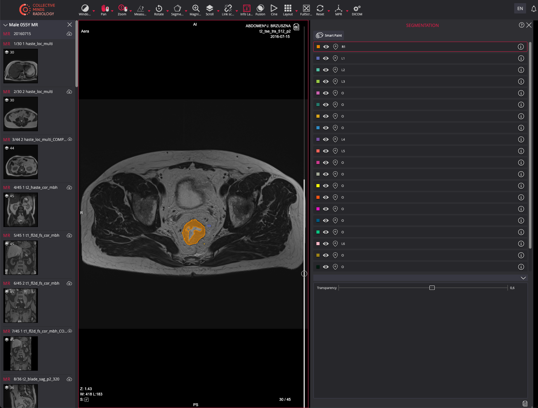 Collective Minds Reserach DICOM Segmentation RTSTRUCT Rectal Cancer Lymph Node Lesions Collective Minds Reserach DICOM Segmentation RTSTRUCT Rectal Cancer Lymph Node Lesions