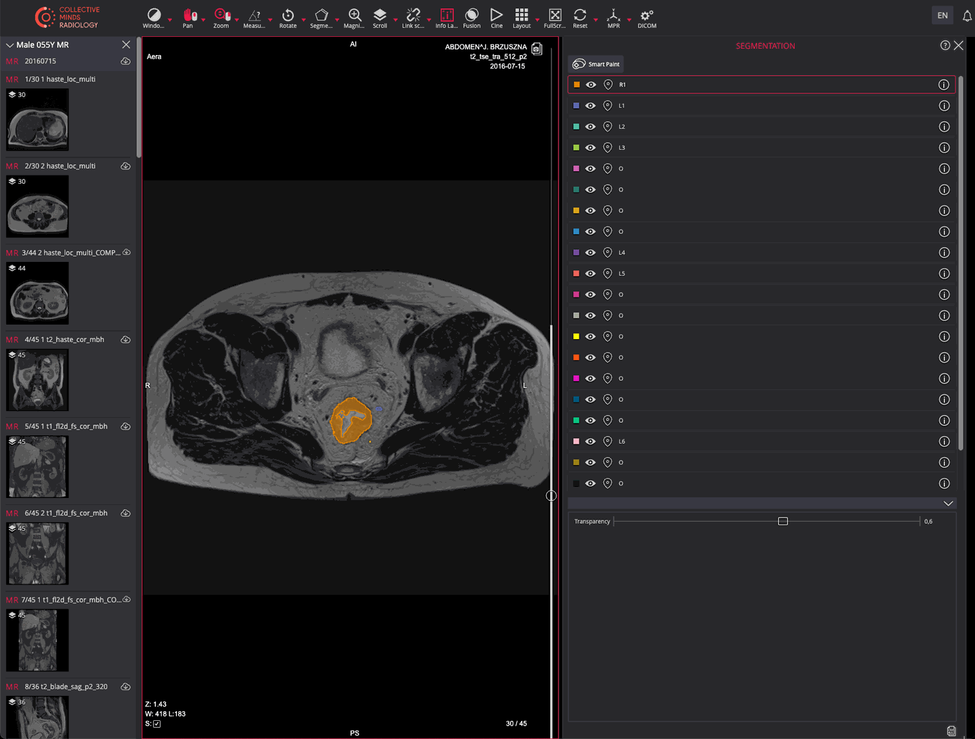 Rtstruct Annotations DICOM RTSTRUCT Segmentation | Collective Minds Research 2025