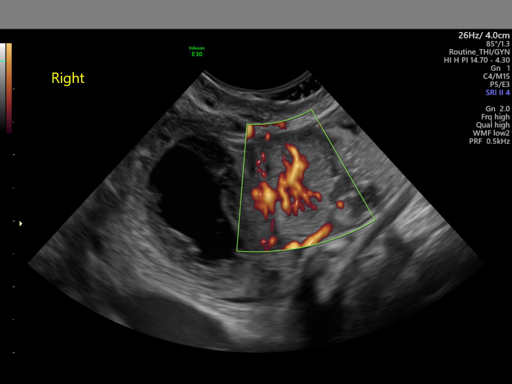 Collective Minds Ultrasound US study anonymized grey pixel overlay