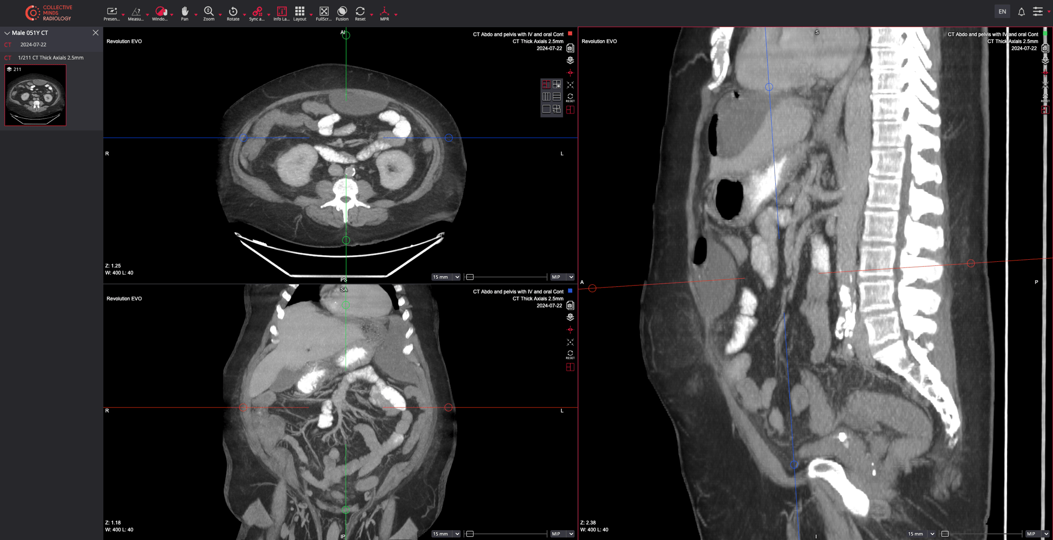 CT Scan Radiation Dose Chart: mSv Levels by Scan Type