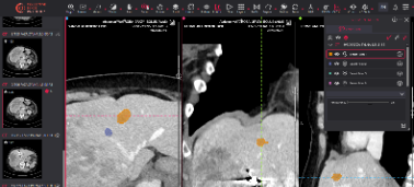 Oncology Clinical Trial CT