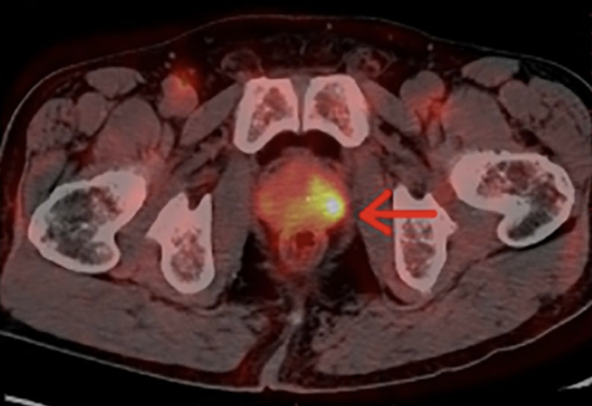 PET MR cancer imaging biomarker PET MR cancer imaging biomarker