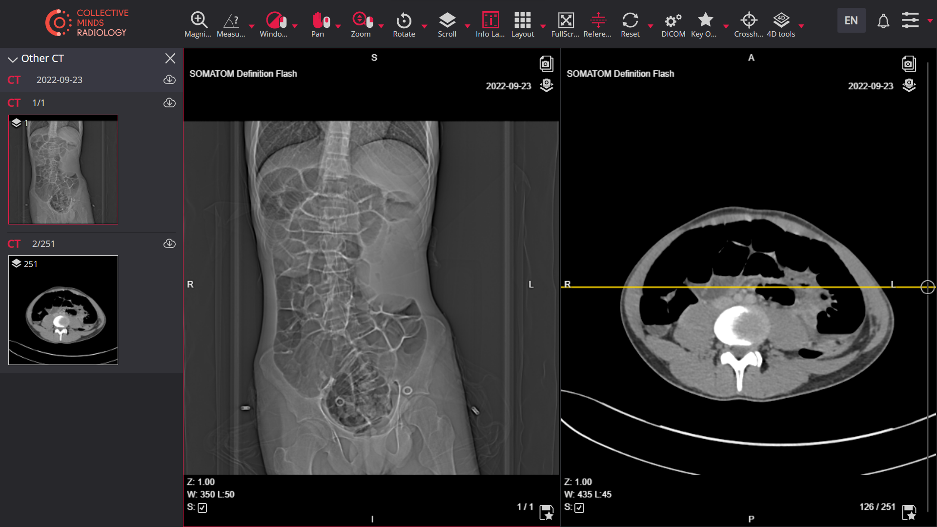 viewer spleen 1