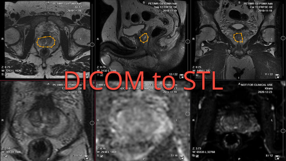 collective minds research segmentation DICOM to STL collective minds research segmentation DICOM to STL