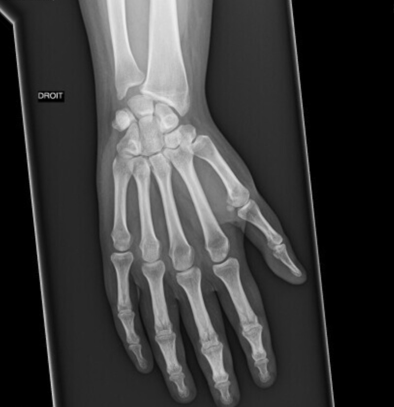 X-ray of a right hand and wrist, the type of radiograph used to score joint erosion and structural damage in rheumatology clinical trials